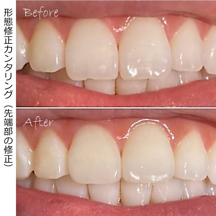 前歯のギザギザと大きさを解消した例