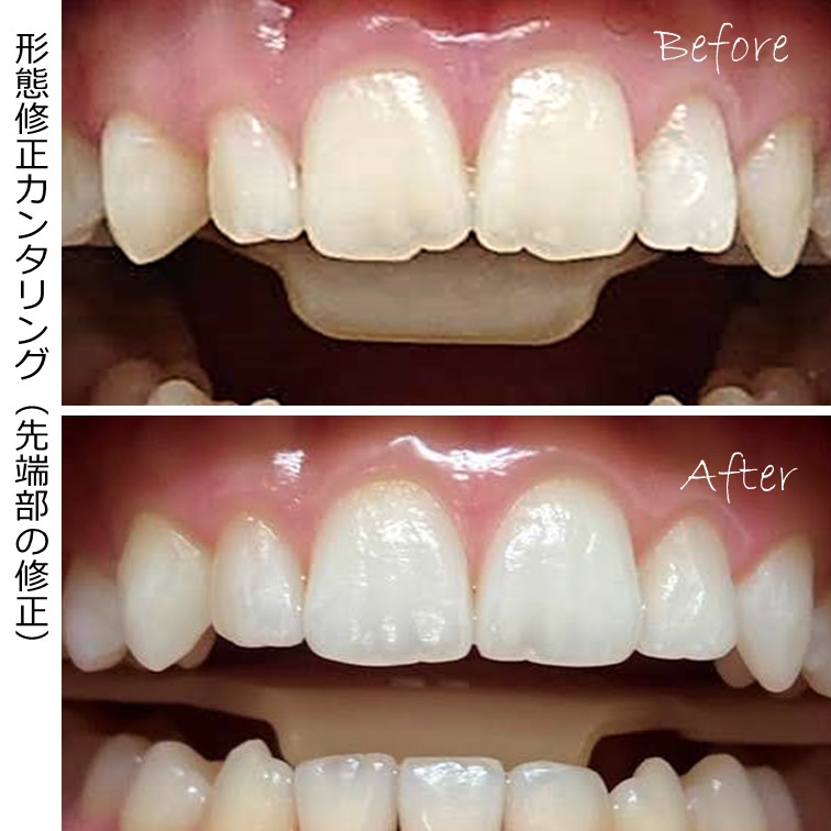 前歯のギザギザを解消した例