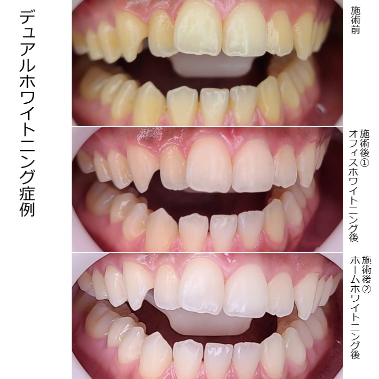 ホワイトニング症例集 | 審美歯科 札幌デンタルケア