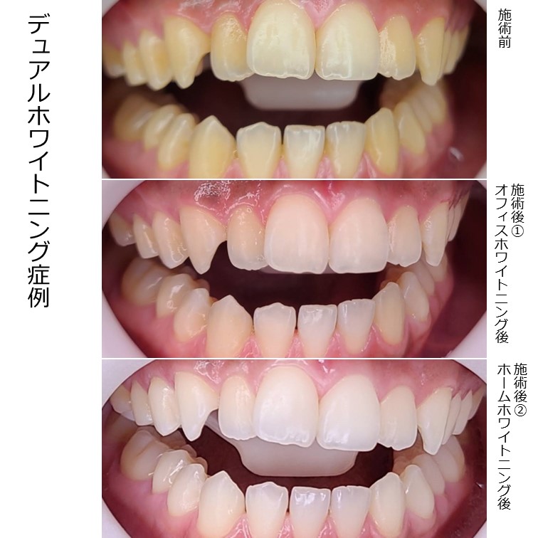 歯のホワイトニングホームケア！12回分