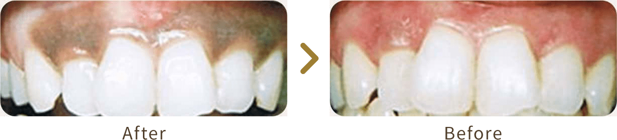 歯茎のホワイトニングのBefore&After
