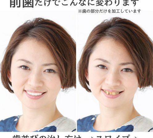マウスピース矯正どれも同じと思っていませ
