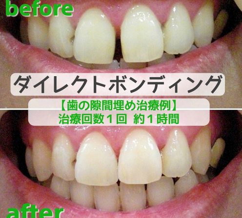 マウスピース矯正どれも同じと思っていませ