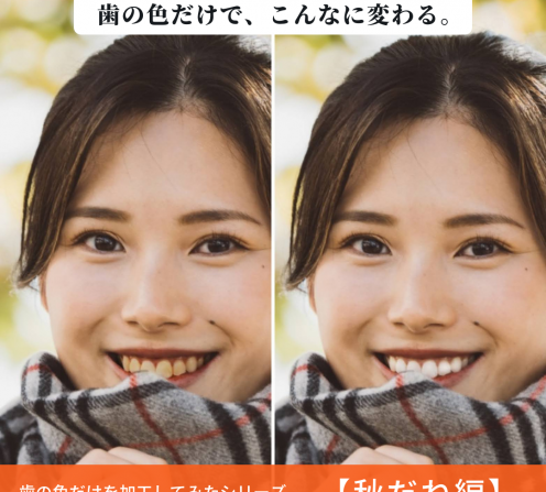 １日で歯並び改善「ダイレクトボンディング