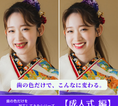 １日で歯並び改善「ダイレクトボンディング