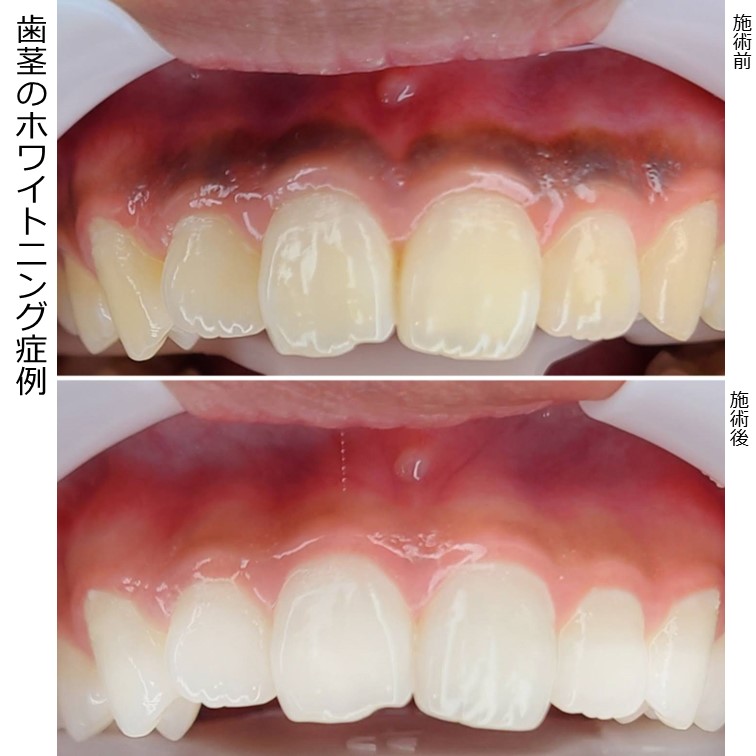 色素沈着してしまった歯茎